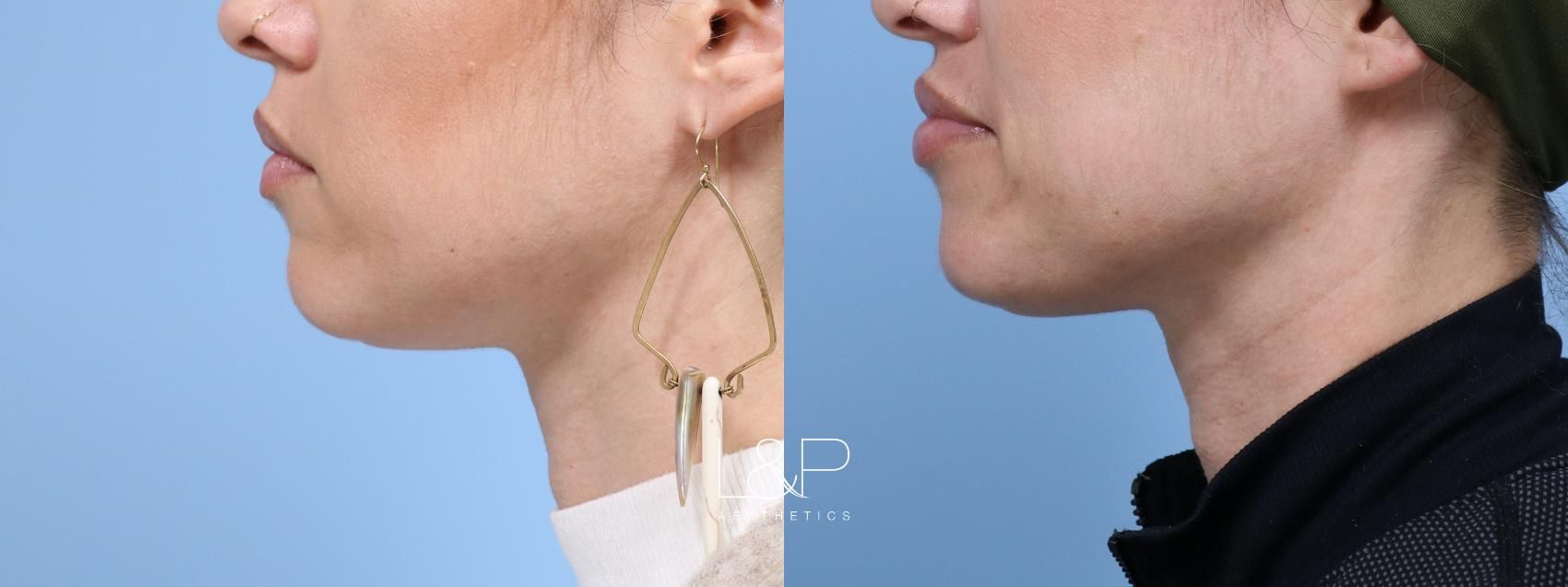 Facial Fillers before and after treatment