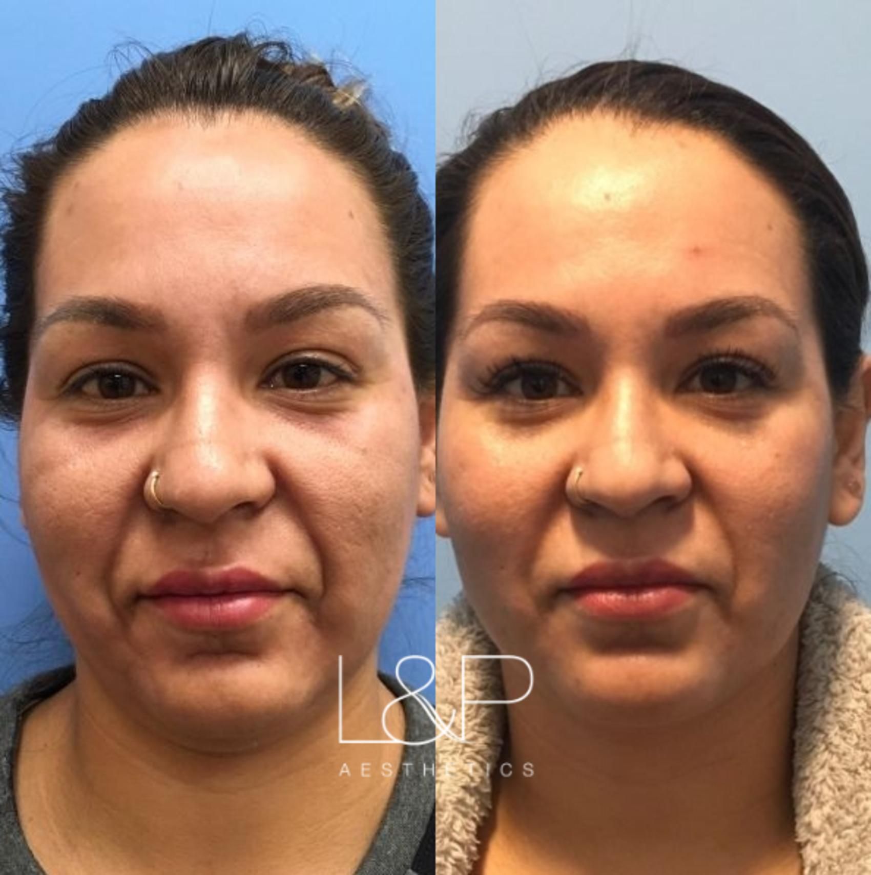 Facial Fillers before and after treatment