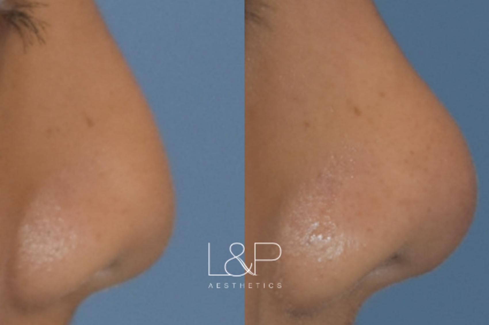Facial Fillers before and after treatment