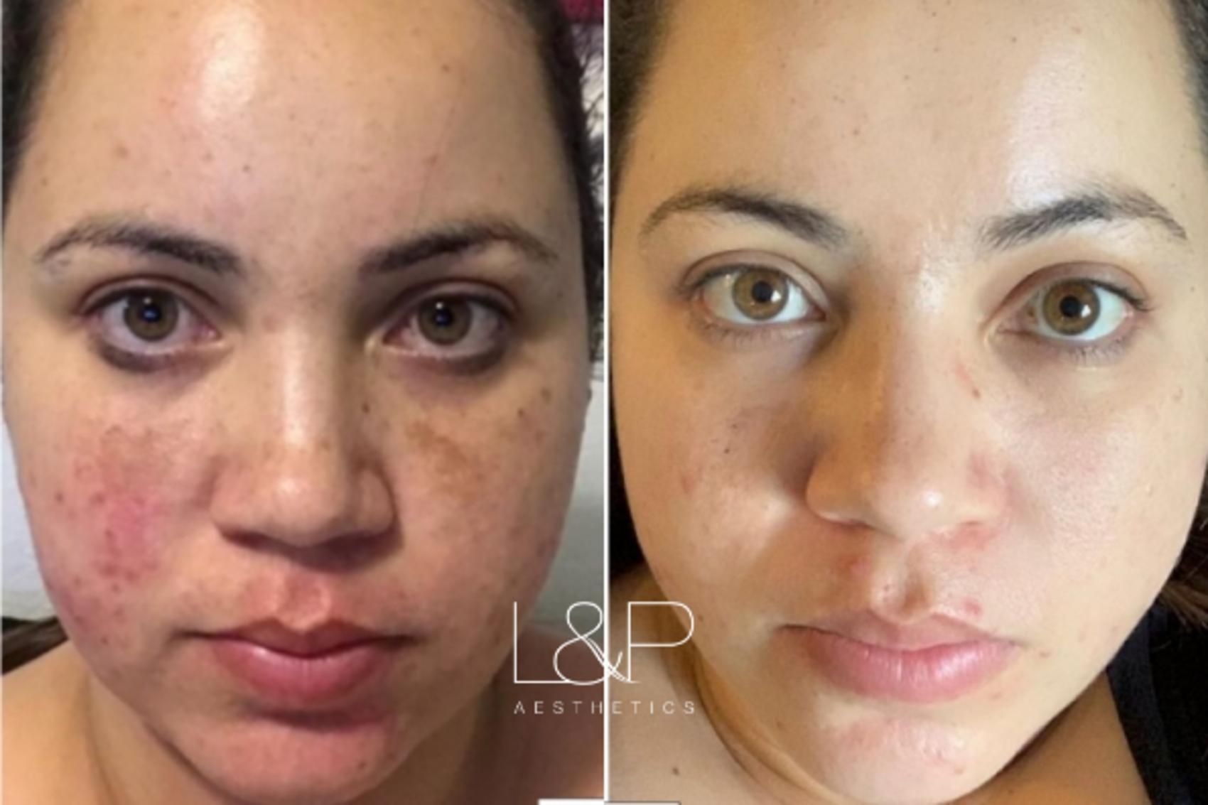 Young BBL before and after treatment