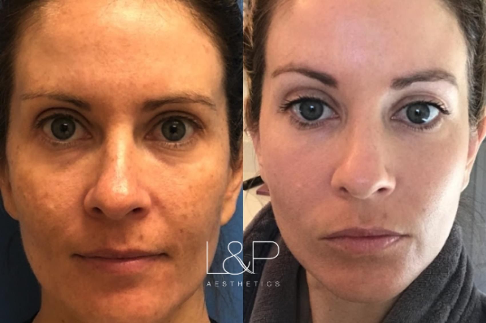 Young BBL before and after treatment