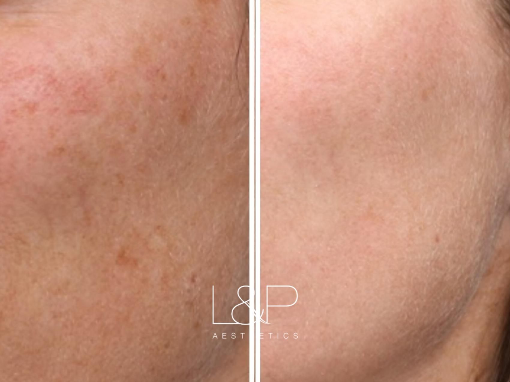 Young BBL before and after treatment
