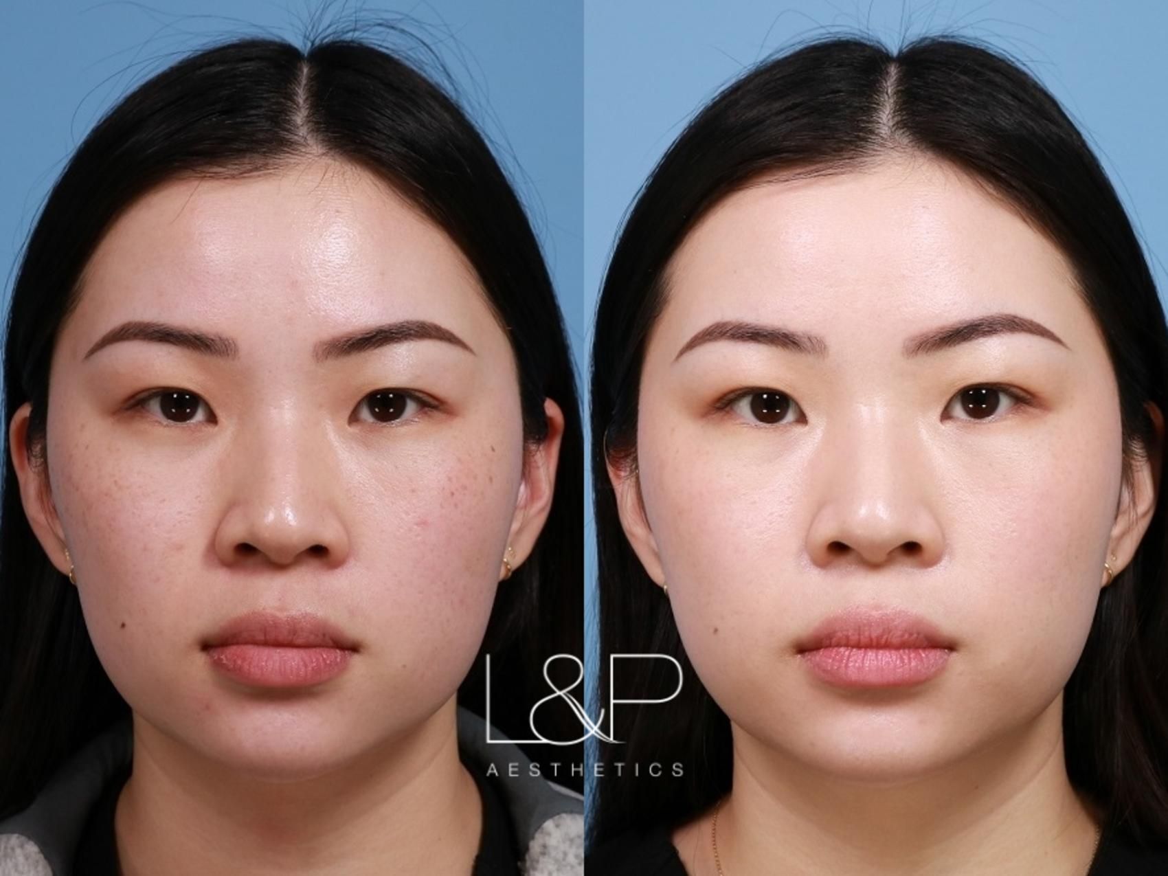 Young BBL before and after treatment
