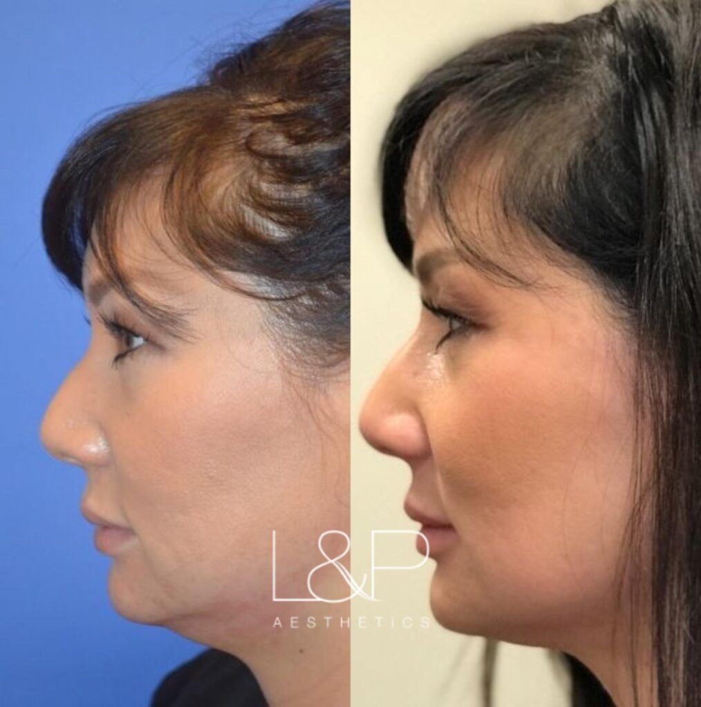 Kybella before and after treatment
