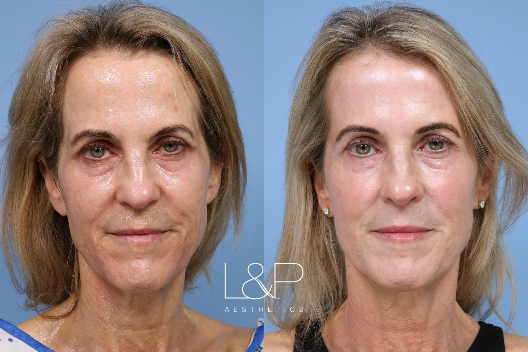 Laser Resurfacing before and after treatment in Los Gatos, California