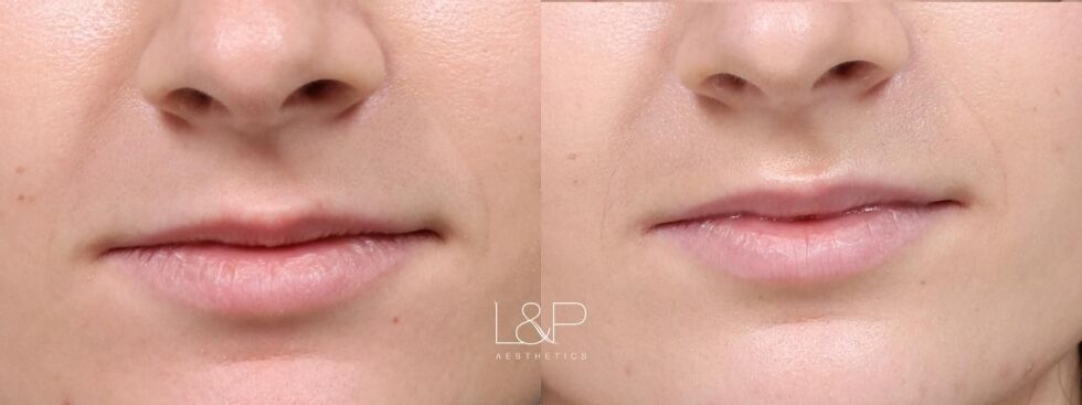 Lip Augmentation before and after treatment