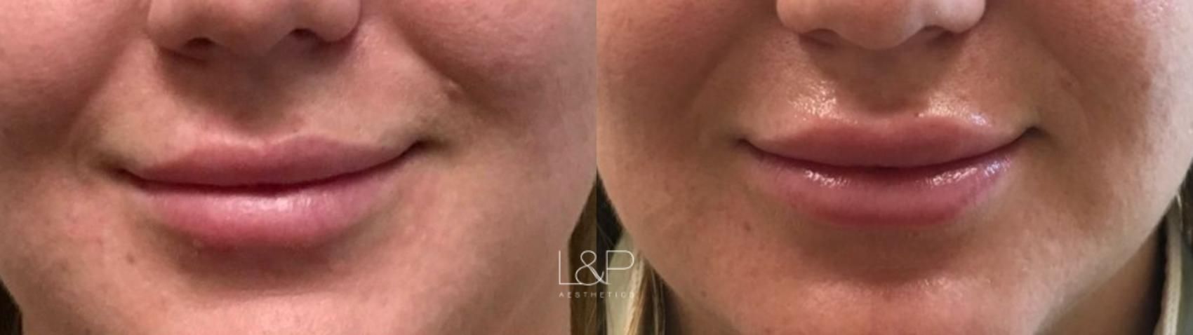 Lip Augmentation before and after treatment