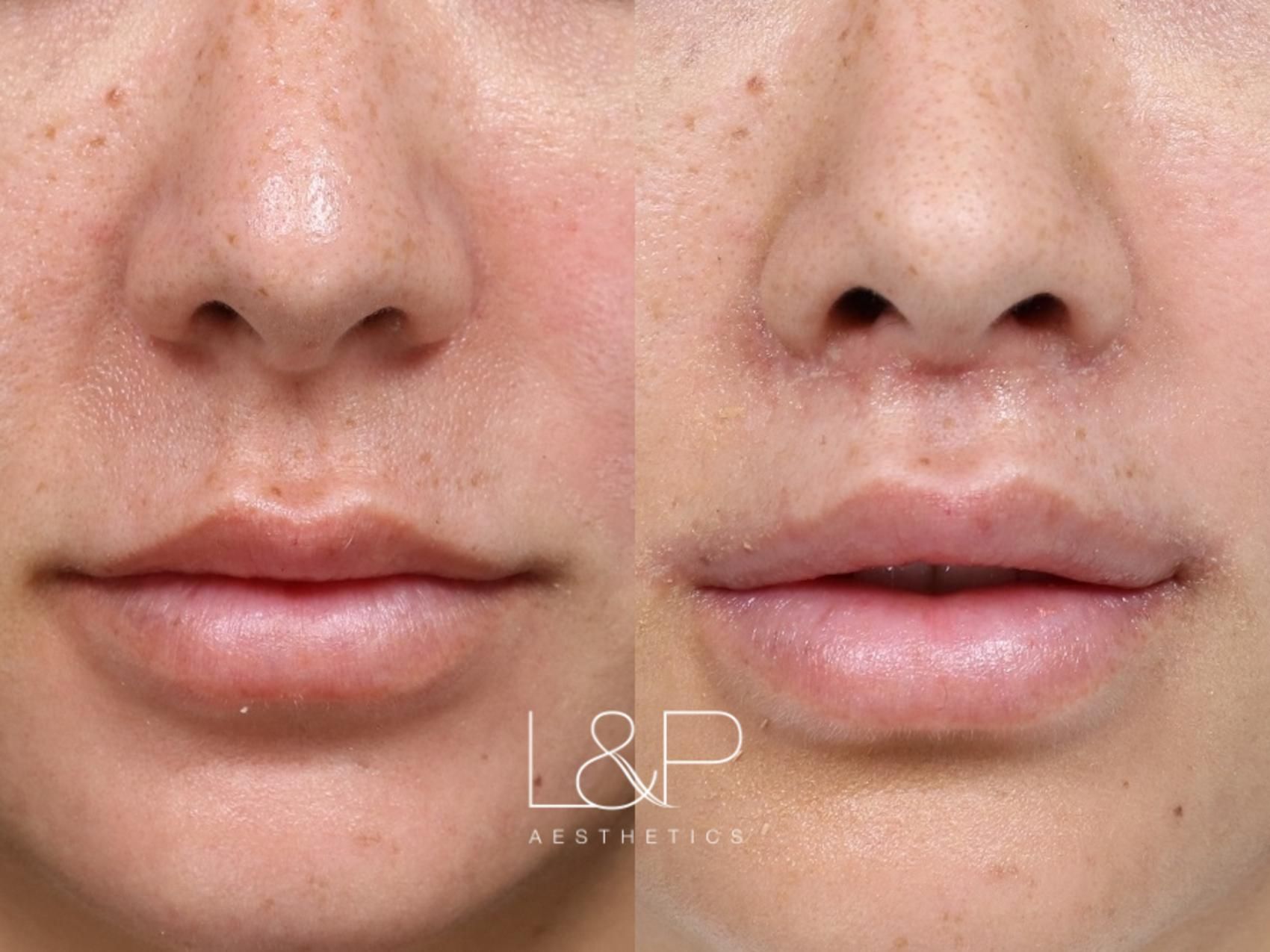 Lip Lift before and after treatment in Los Gatos, CA