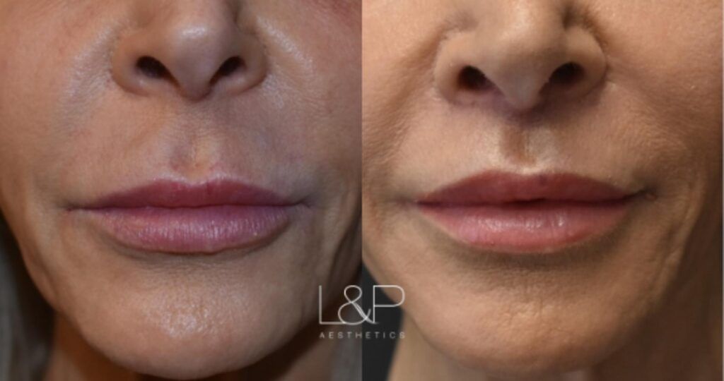 Lip Lift before and after treatment in Los Gatos, California