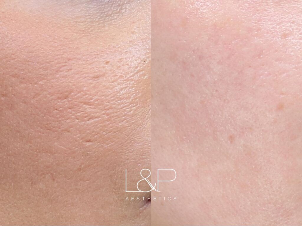 Microneedling Before and after treatment