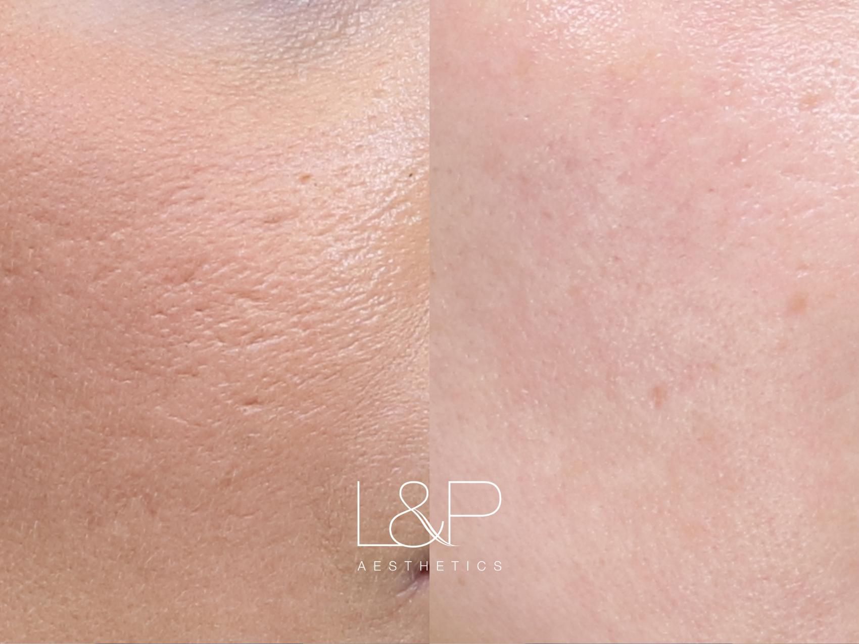 Microneedling Before and after treatment
