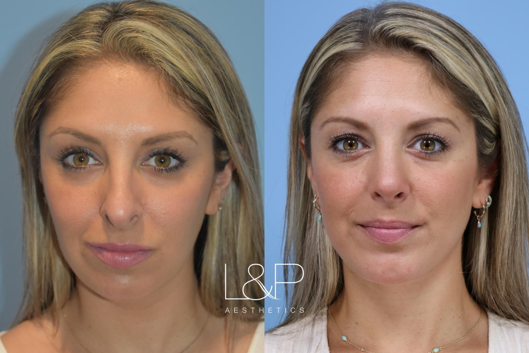 Rhinoplasty & Midline Neck Lift before and after treatment in Palo Alto, California
