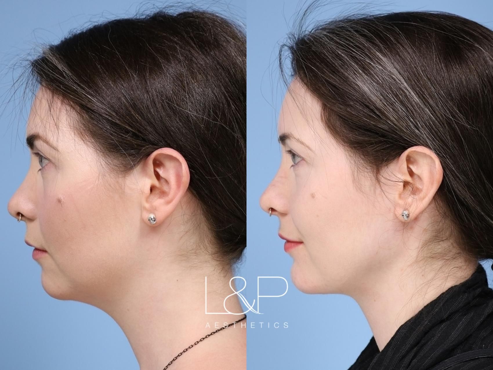 Midline Neck Lift before and after treatment in California