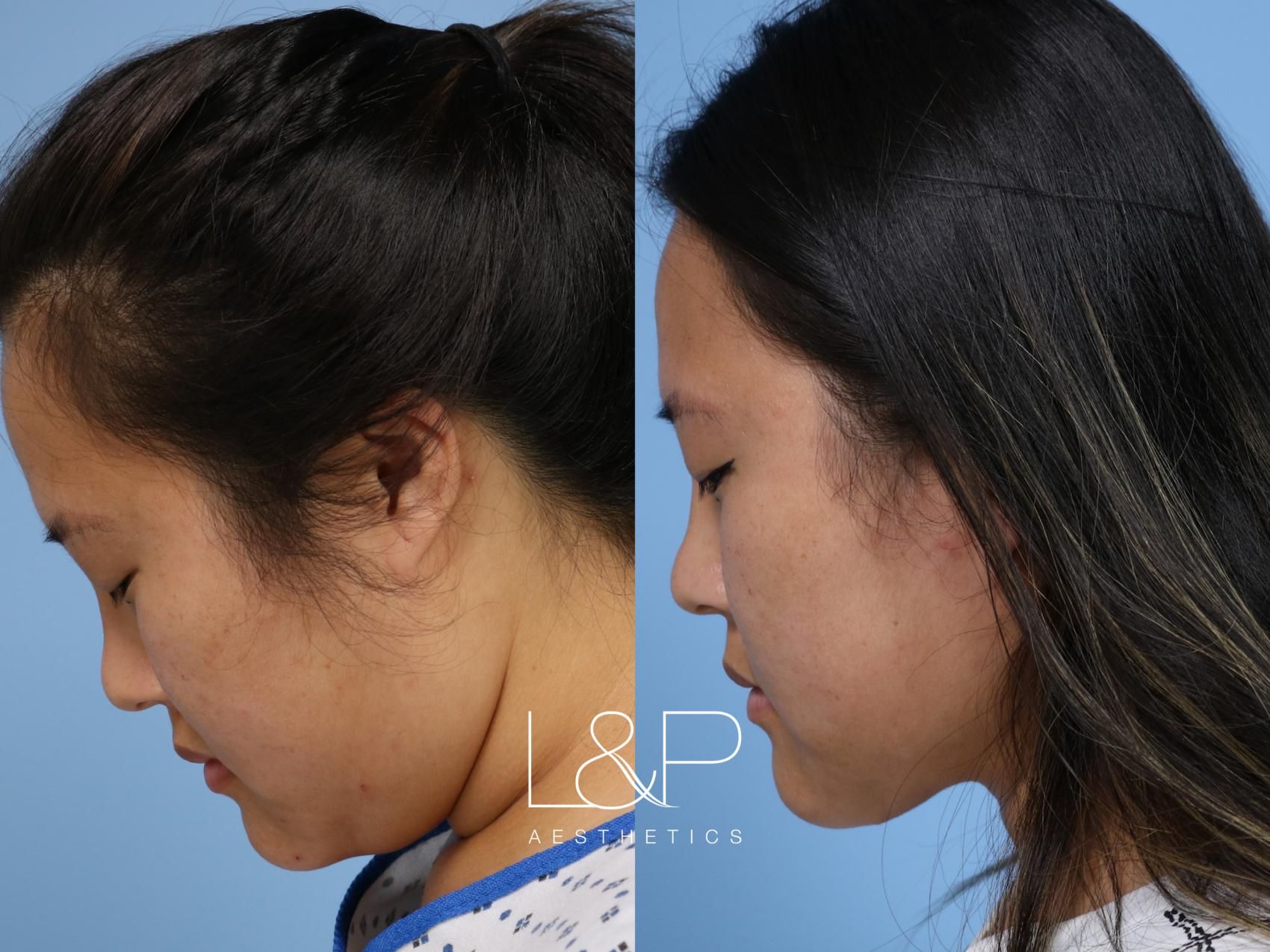 Midline Neck Lift before and after treatment in Los Gatos, CA