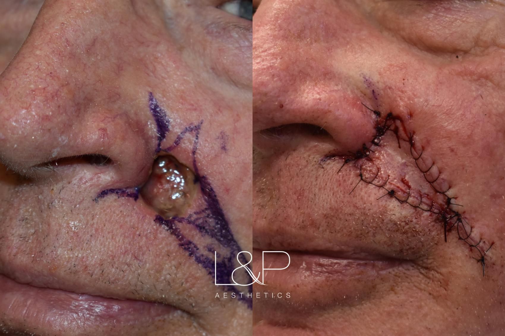 Reconstructive Surgery before and after treatment