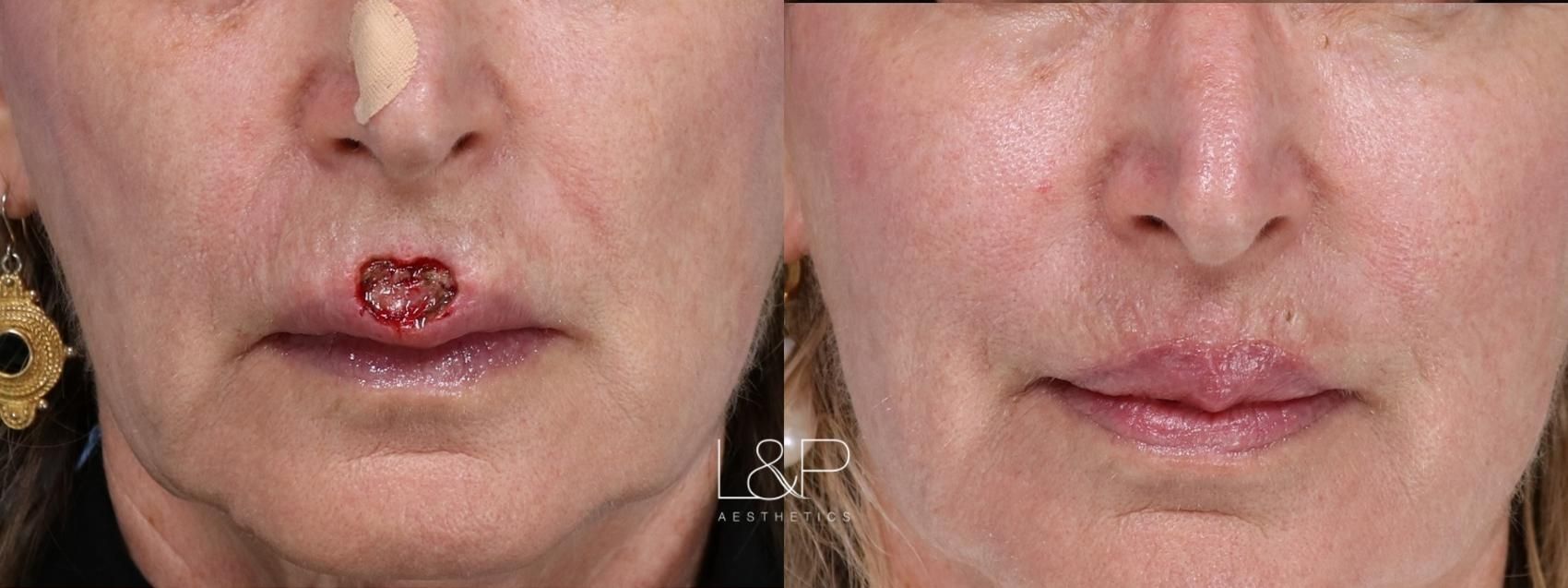 Reconstructive Surgery before and after treatment