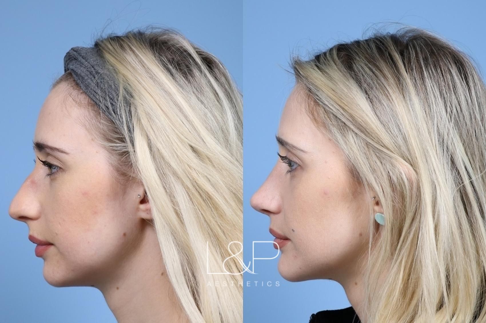 Rhinoplasty before and after treatment in Los Gatos, California