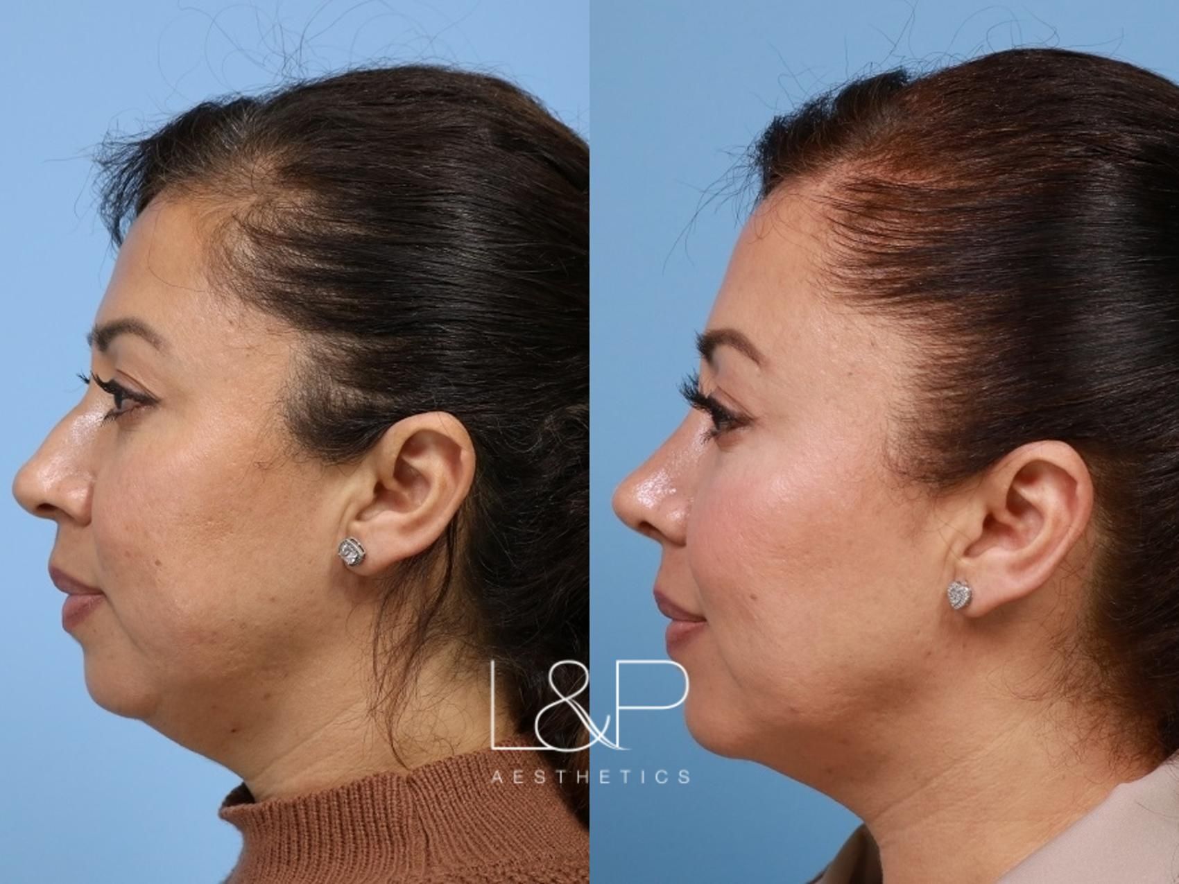 Rhinoplasty before and after treatment in Palo Alto, CA