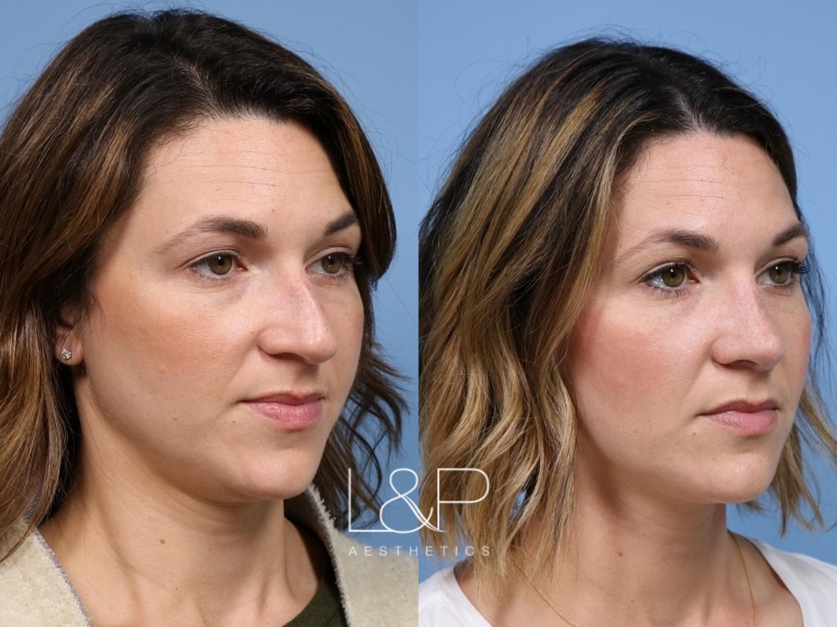 Rhinoplasty before and after treatment in the Bay Area