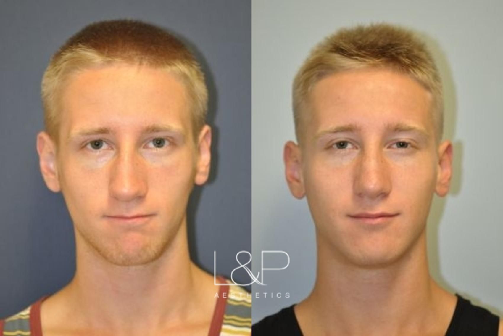 Male Rhinoplasty before and after treatment in Palo Alto, CA