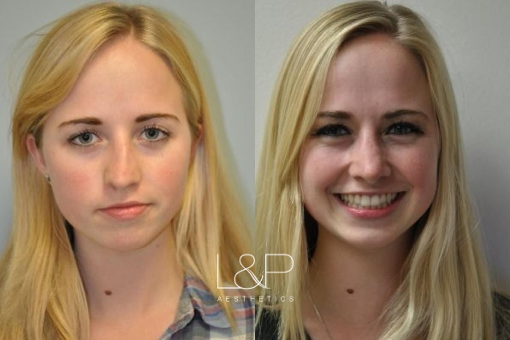 Female Rhinoplasty patient before and after treatment in California