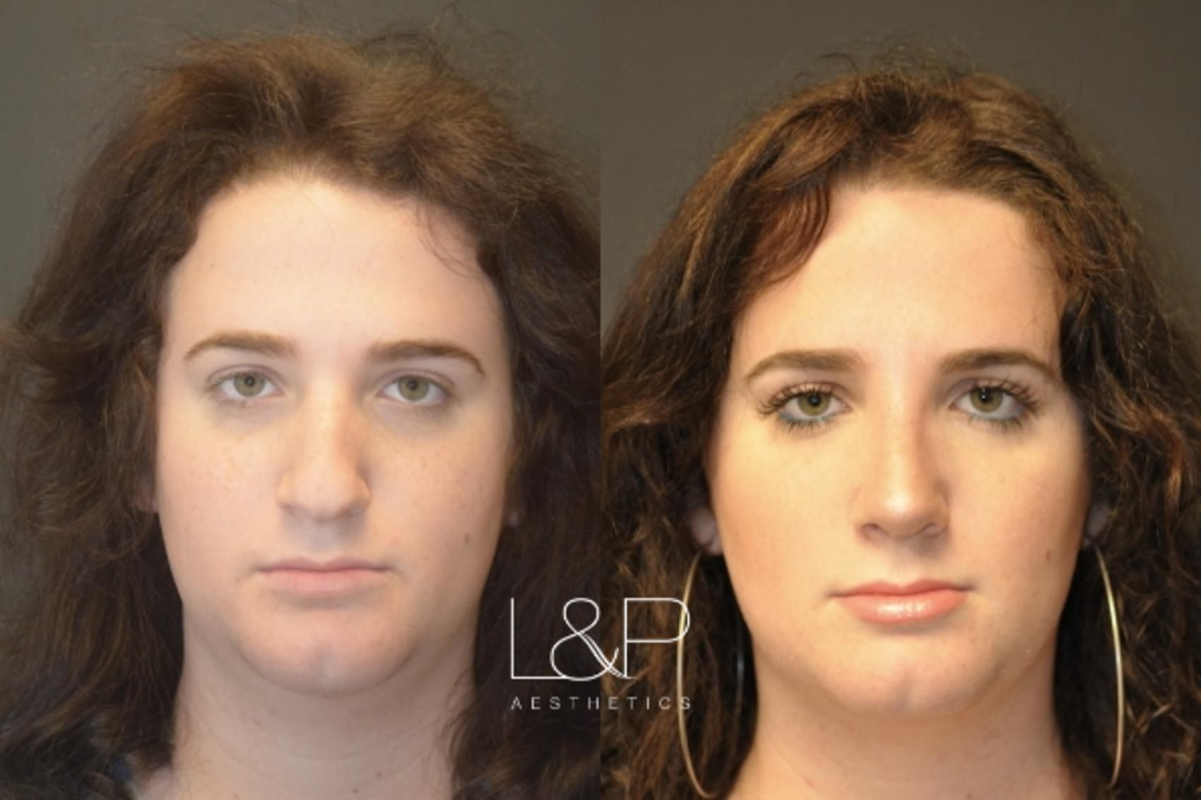 Rhinoplasty Patient before and after treatment in Palo Alto, California