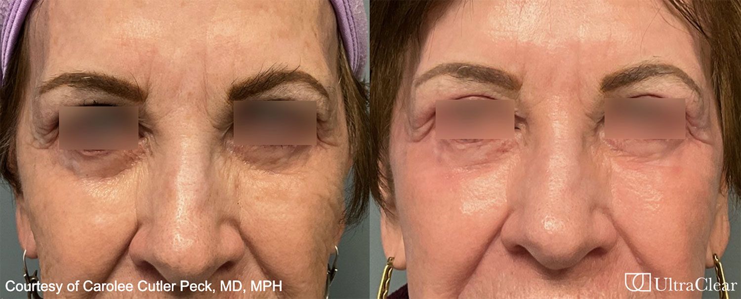 UltraClear Laser Before and After Results in Los Gatos, CA