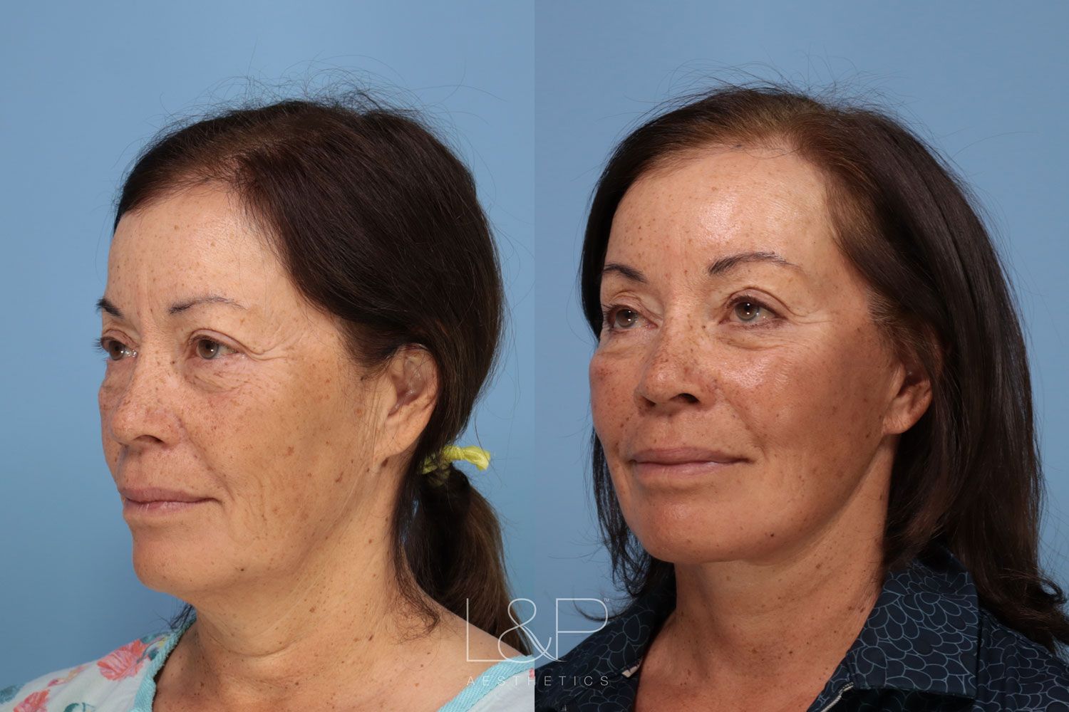 Before and after facelift in California