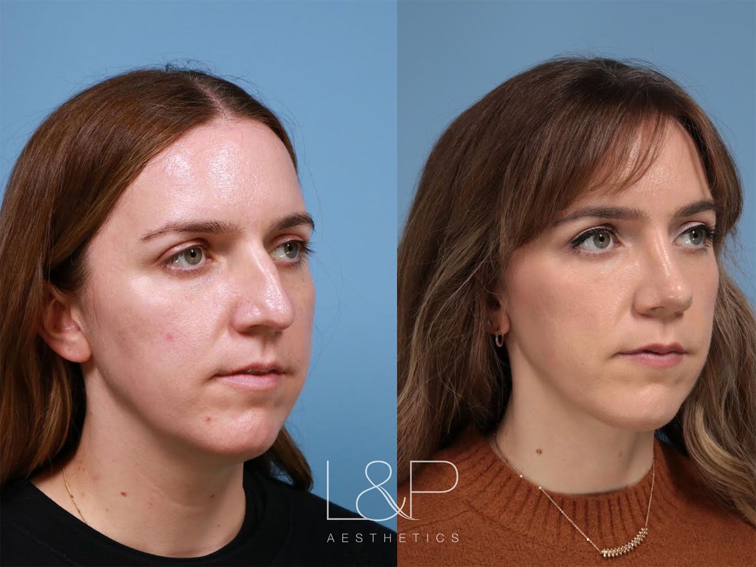 Before and After of a Female Rhinoplasty Patient in Palo Alto, CA
