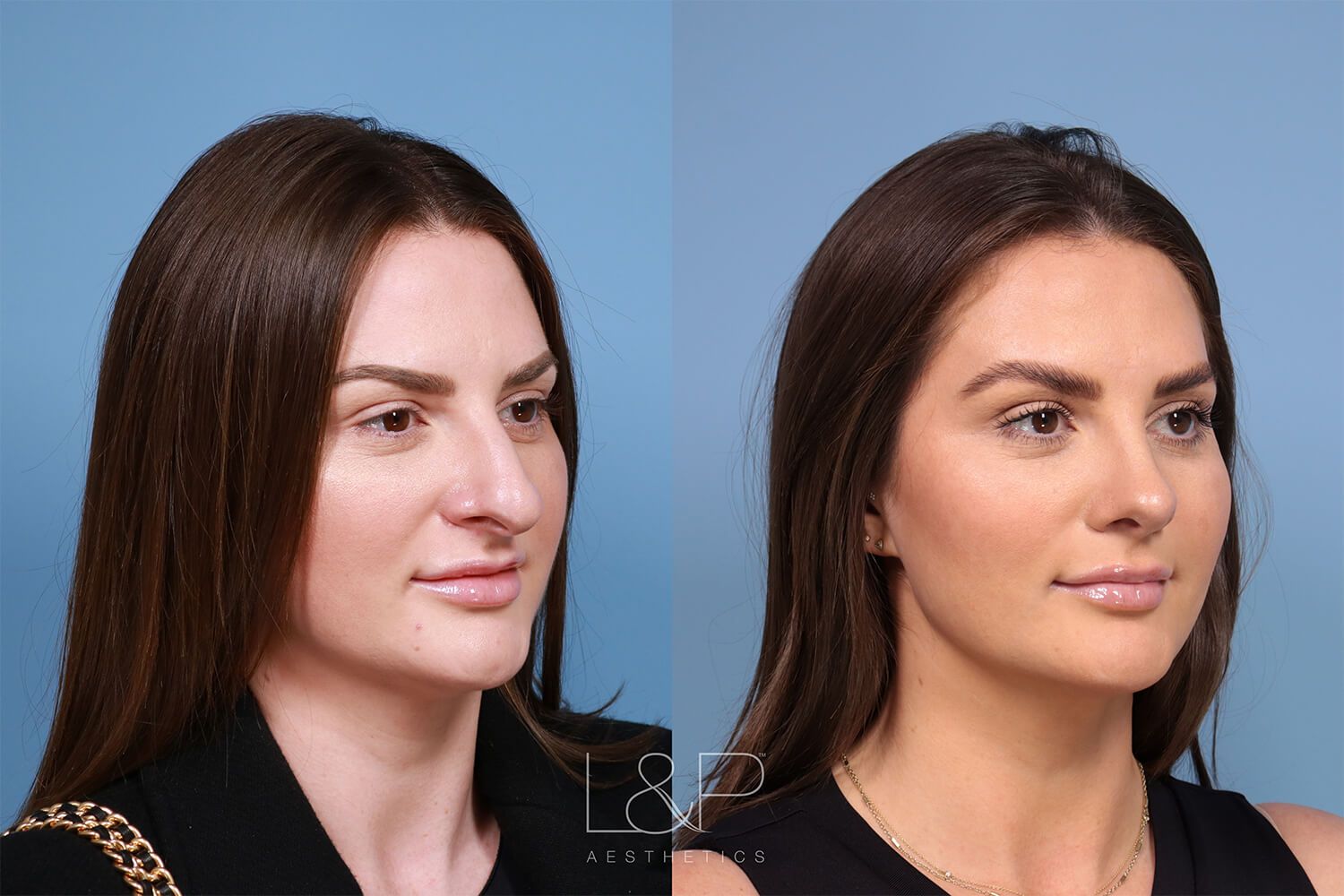 Before and After of a Female Rhinoplasty Patient in Palo Alto, CA
