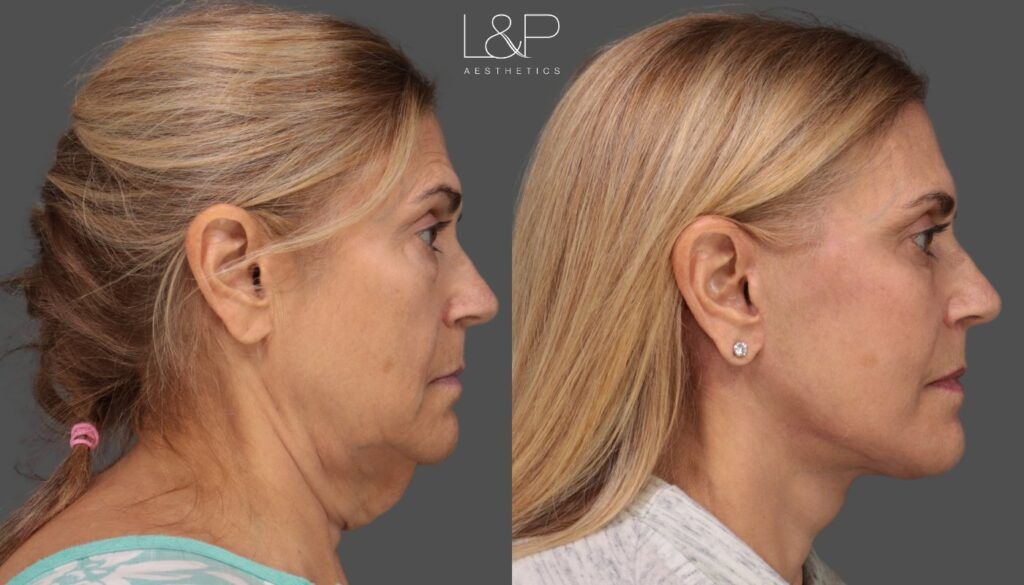 Side by side images of a woman before and after under going a deep plane face and neck lift at L&P Aesthetics