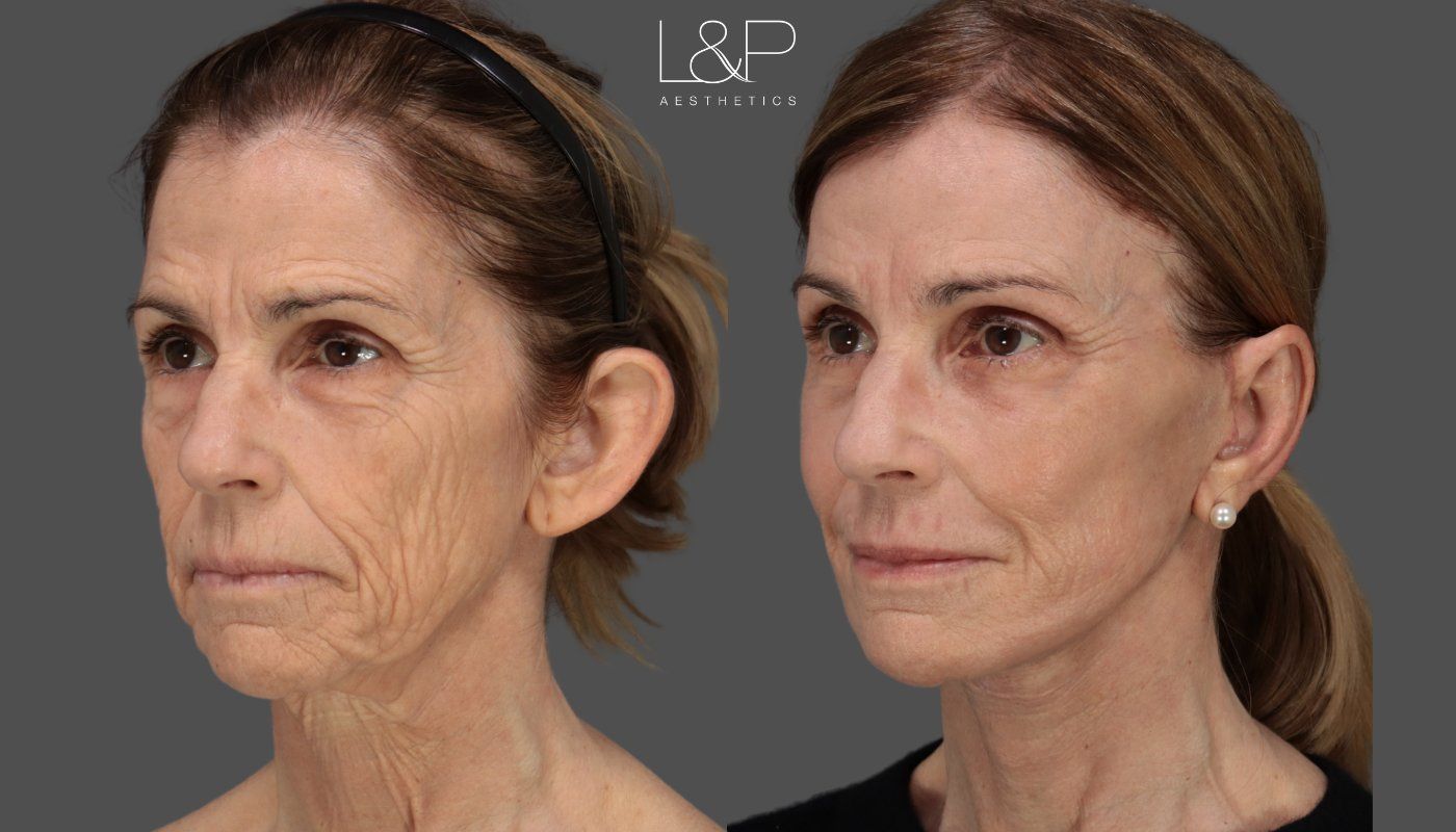 L&P Aesthetics Female facelift before and after images
