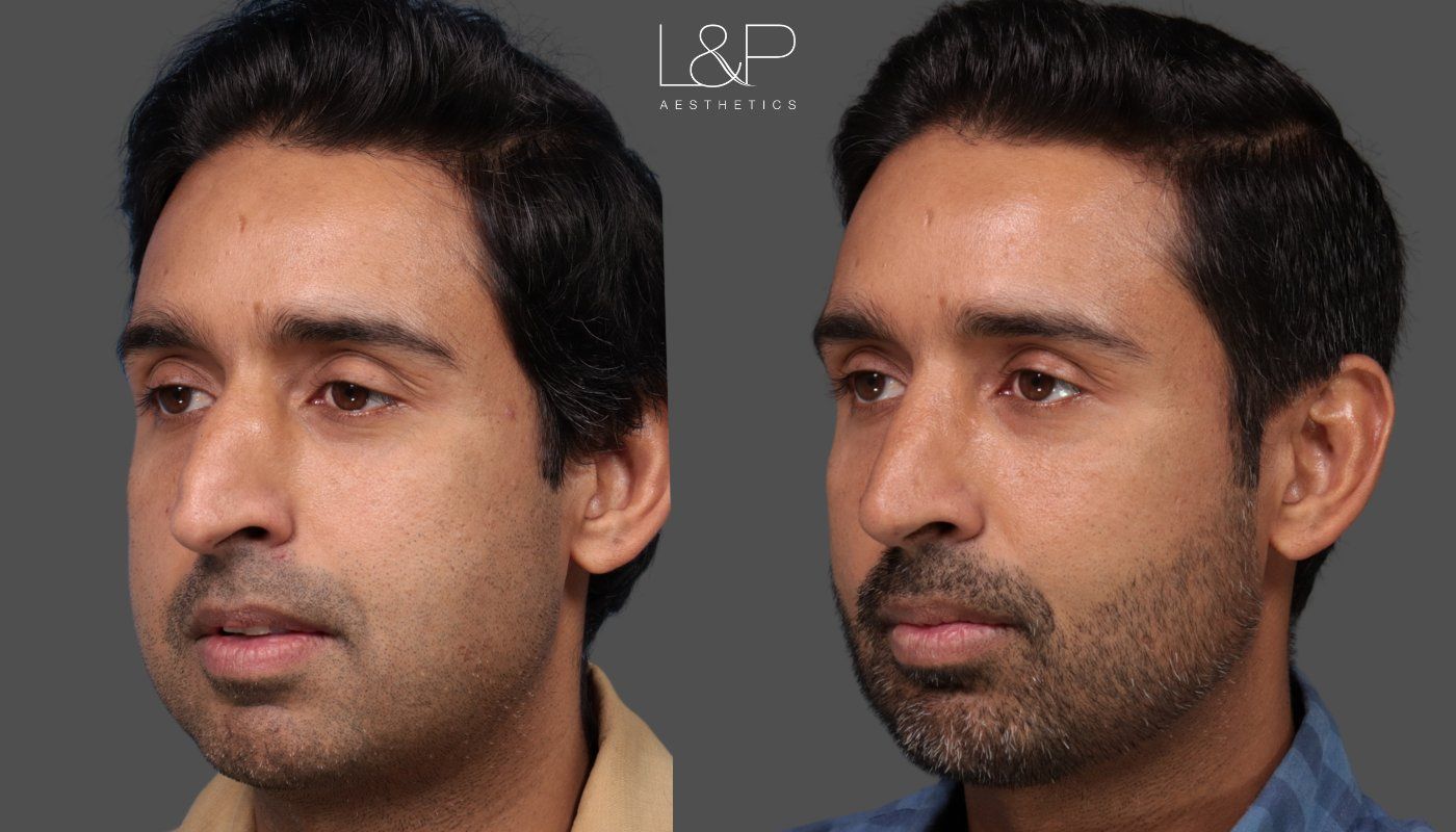 Before and After of a male rhinoplasty patient in Palo Alto
