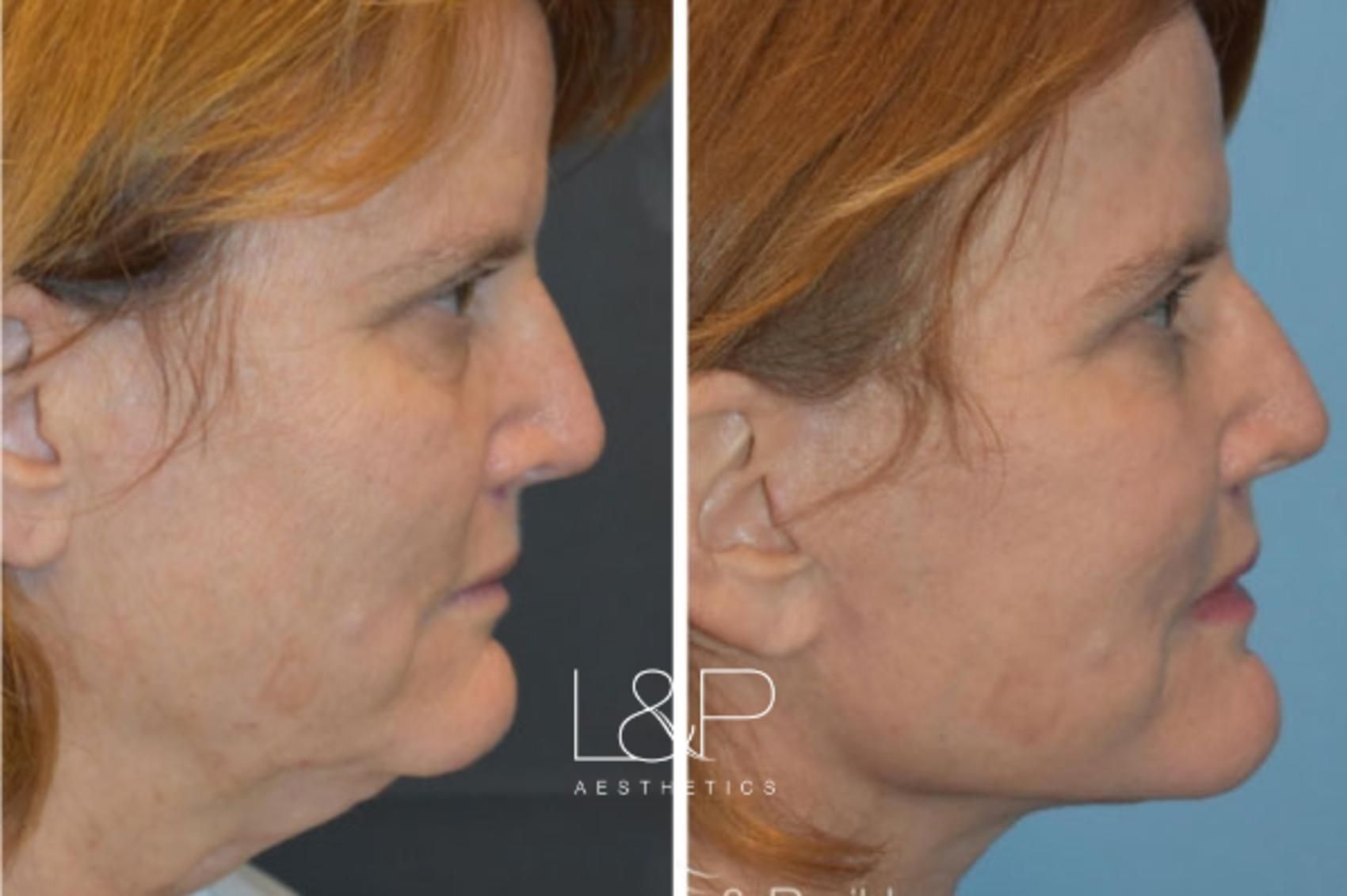 Facelift Neck Lift before and after treatment in Los Gatos, CA