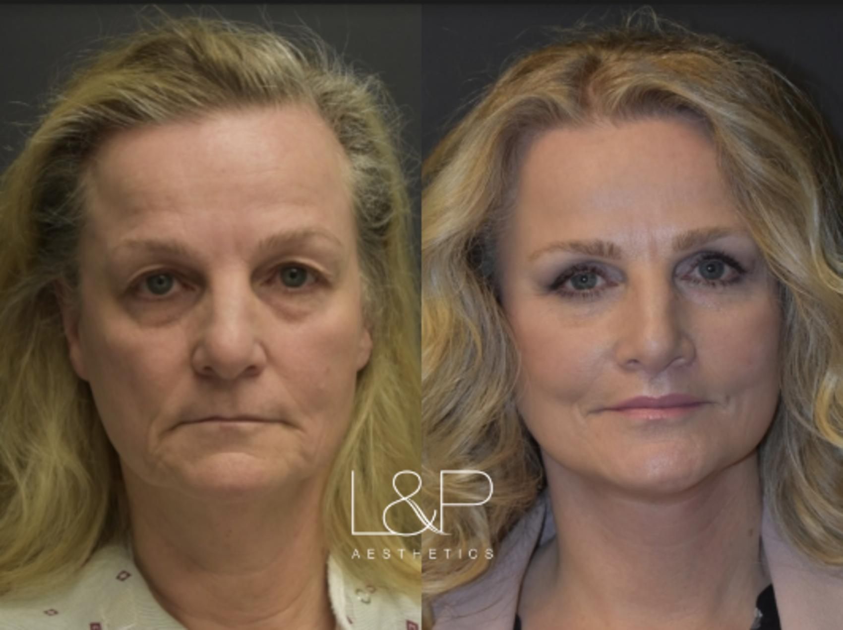 Facelift Neck Lift before and after treatment in California