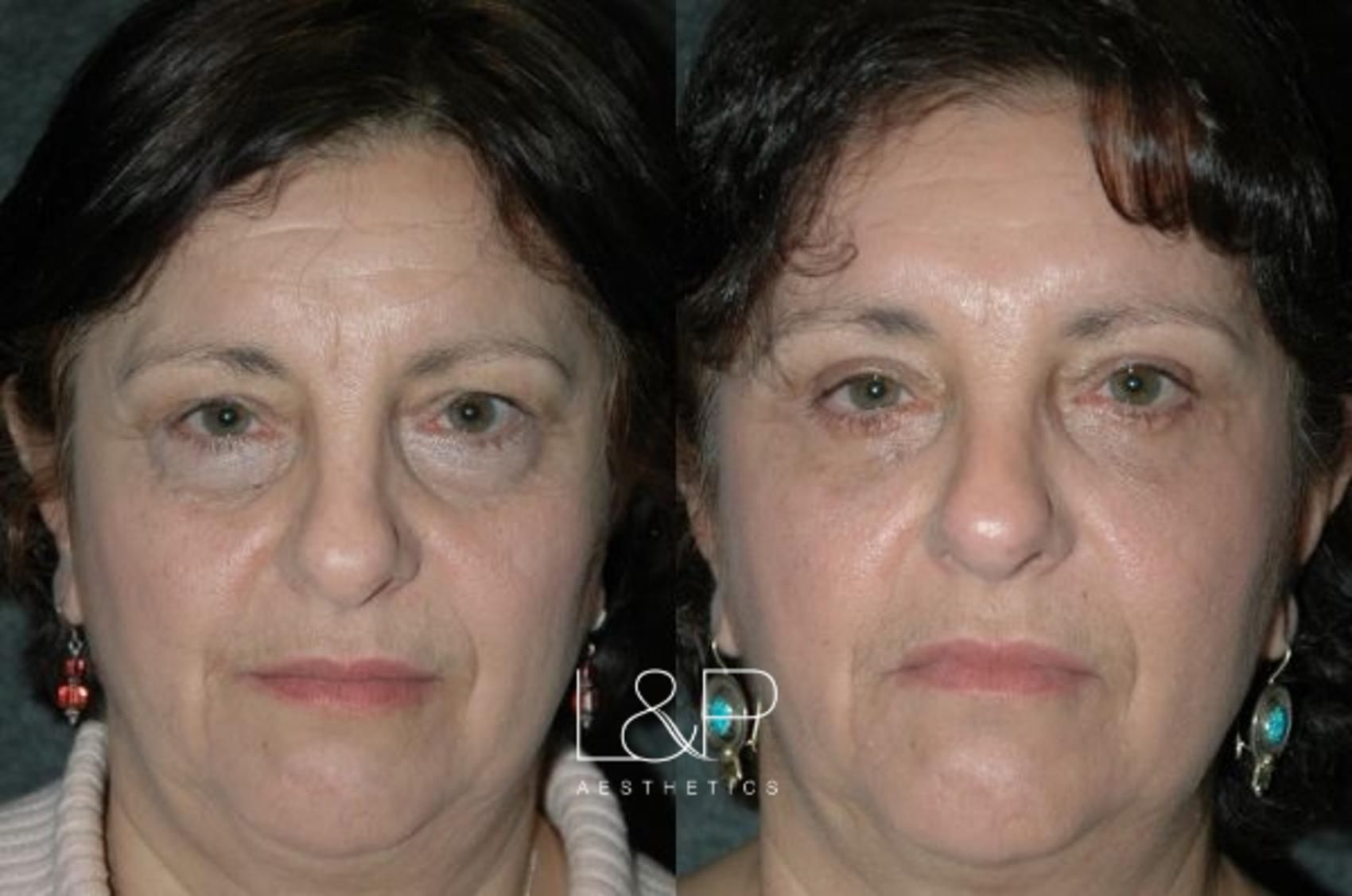 Blepharoplasty before and after treatment