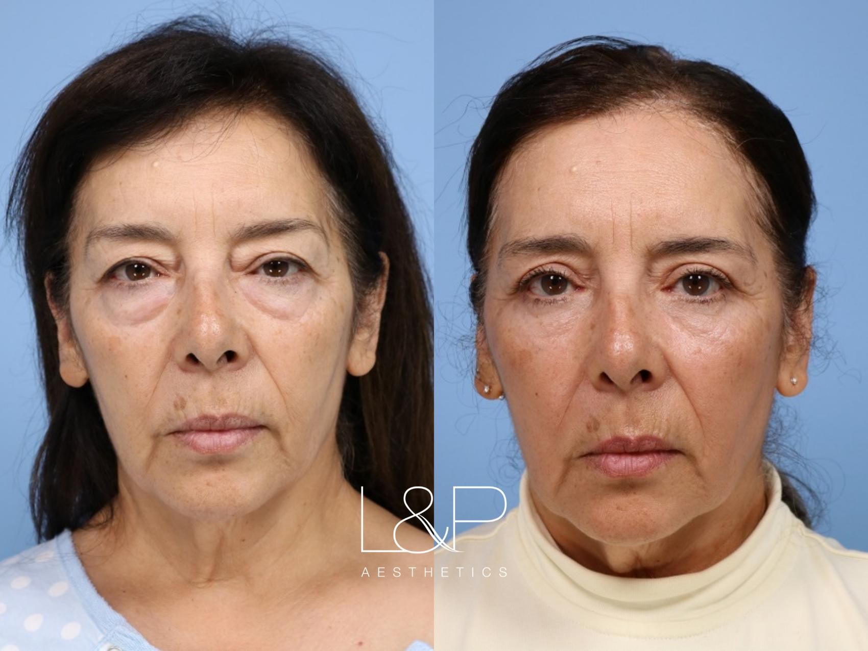 Blepharoplasty before and after treatment