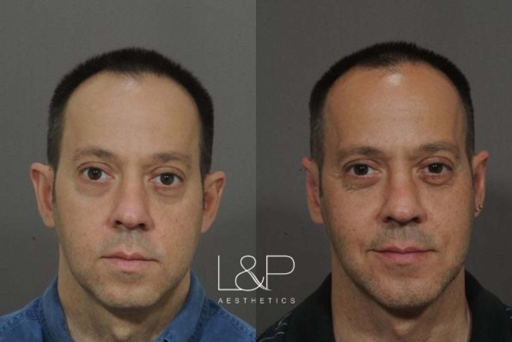 Chin Augmentation before and after treatment