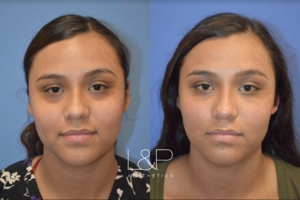 Facial Fillers before and after treatment