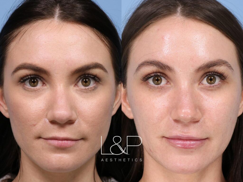 Lip Augmentation Before And After  L&P Aesthetics