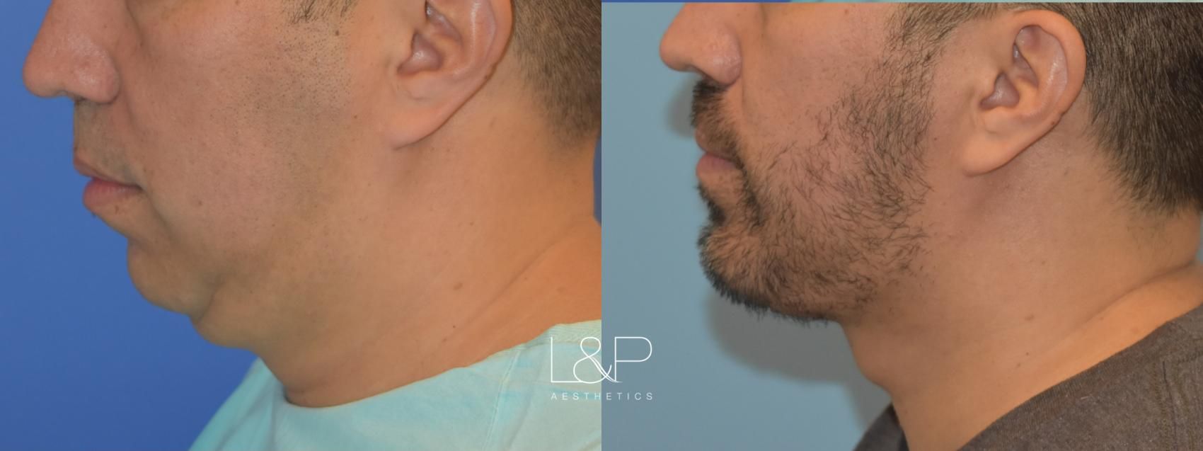 Midline Neck Lift before and after treatment in the Bay Area