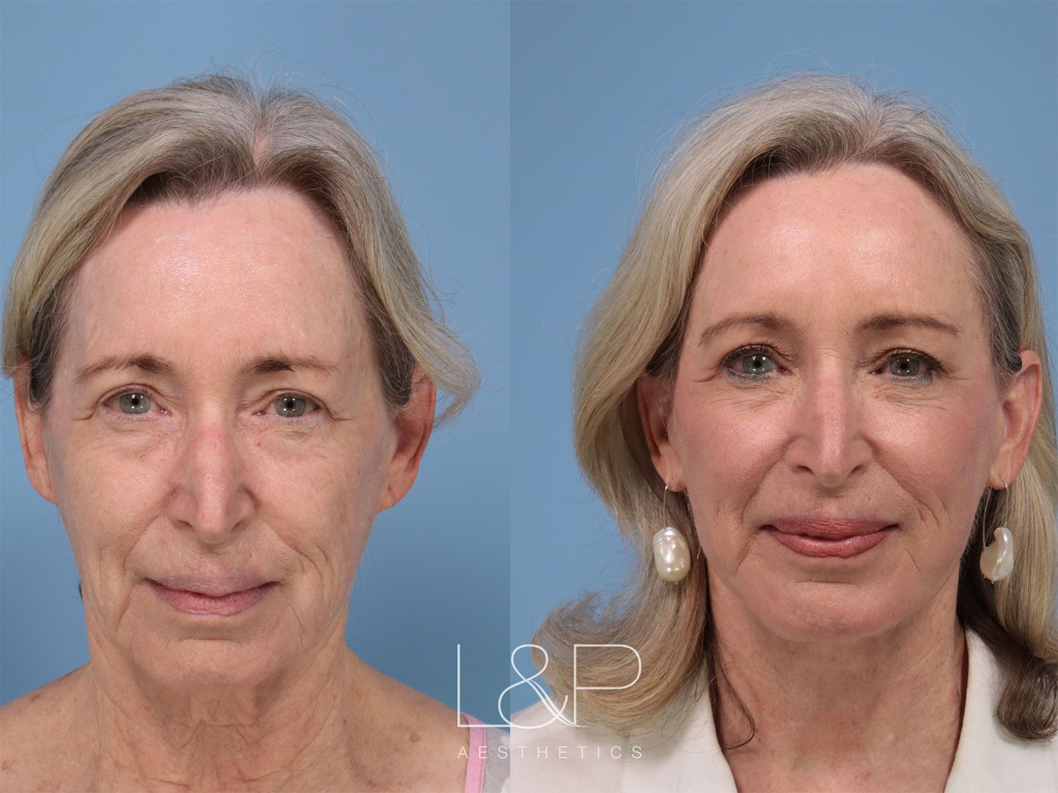 Before and after facelift in Palo Alto, California
