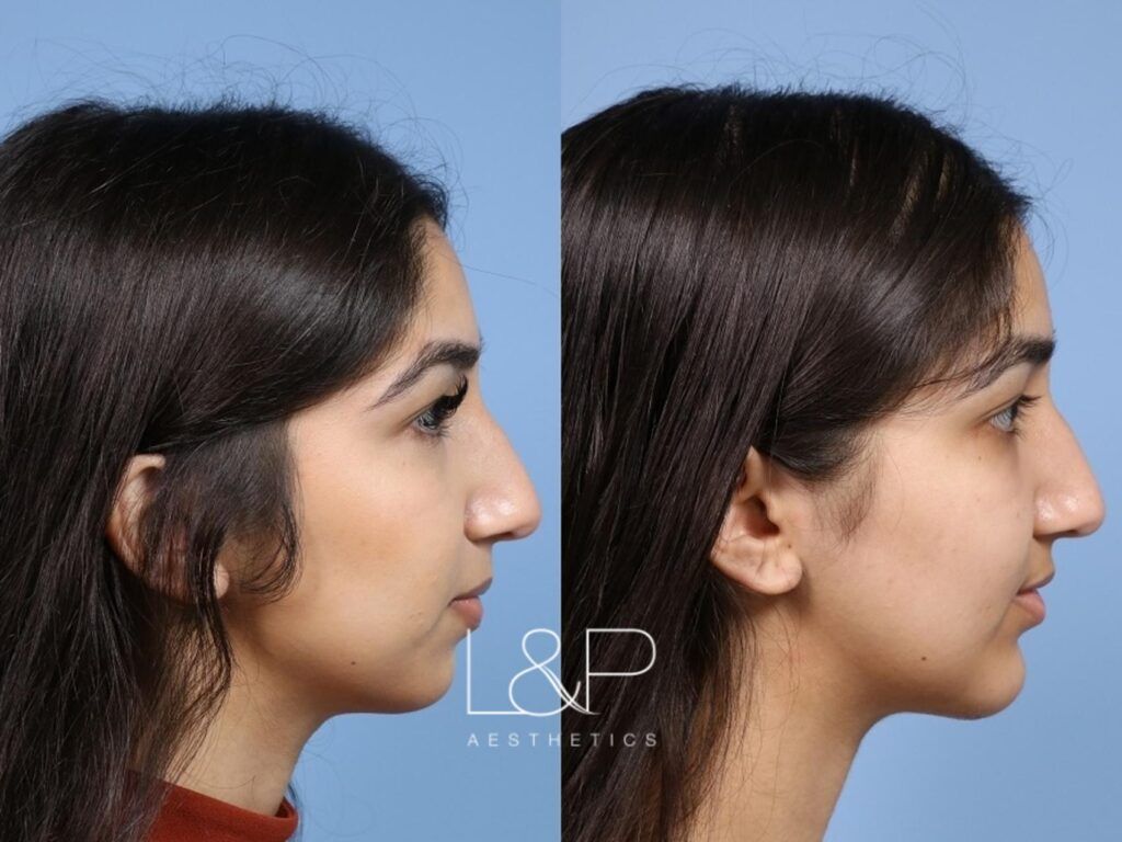 Chin Augmentation Before And After  L&P Aesthetics