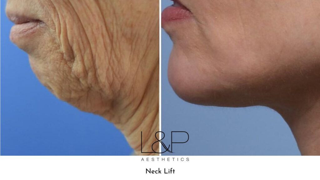 Before and after of a necklift