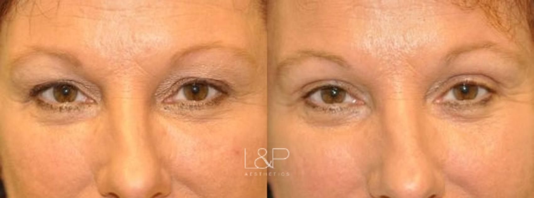 Upper eyelid female blepharoplasty before and after treatment