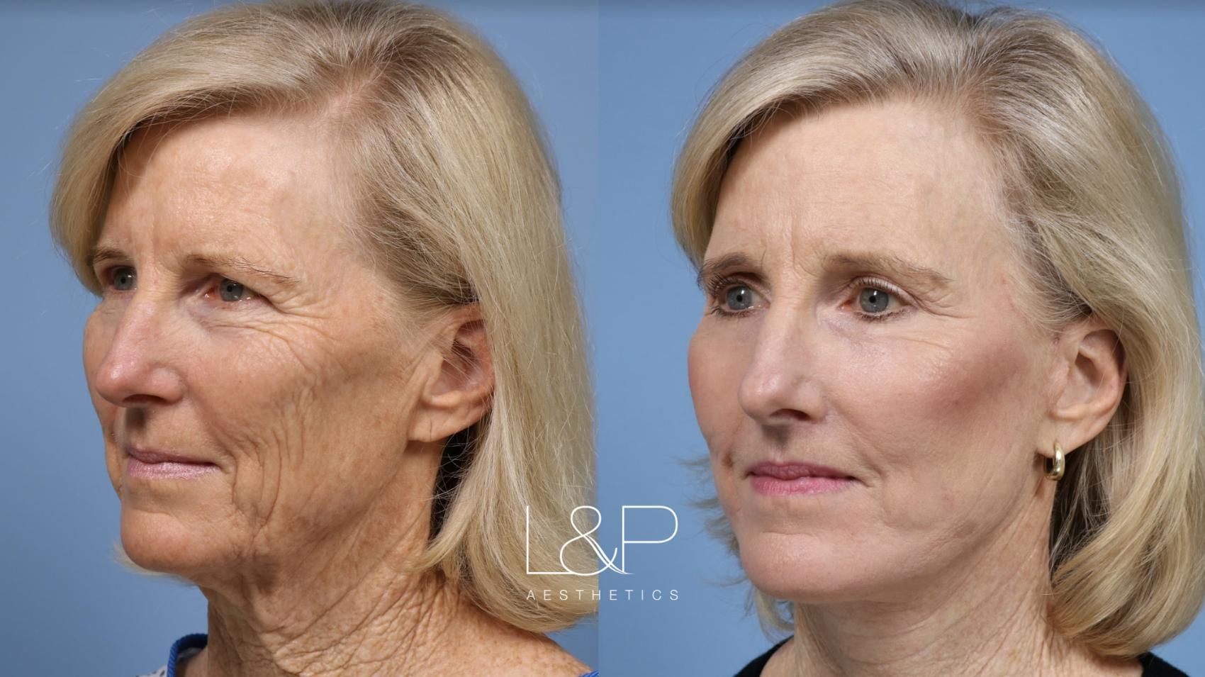 Facelift Neck Lift before and after treatment in the Bay Area