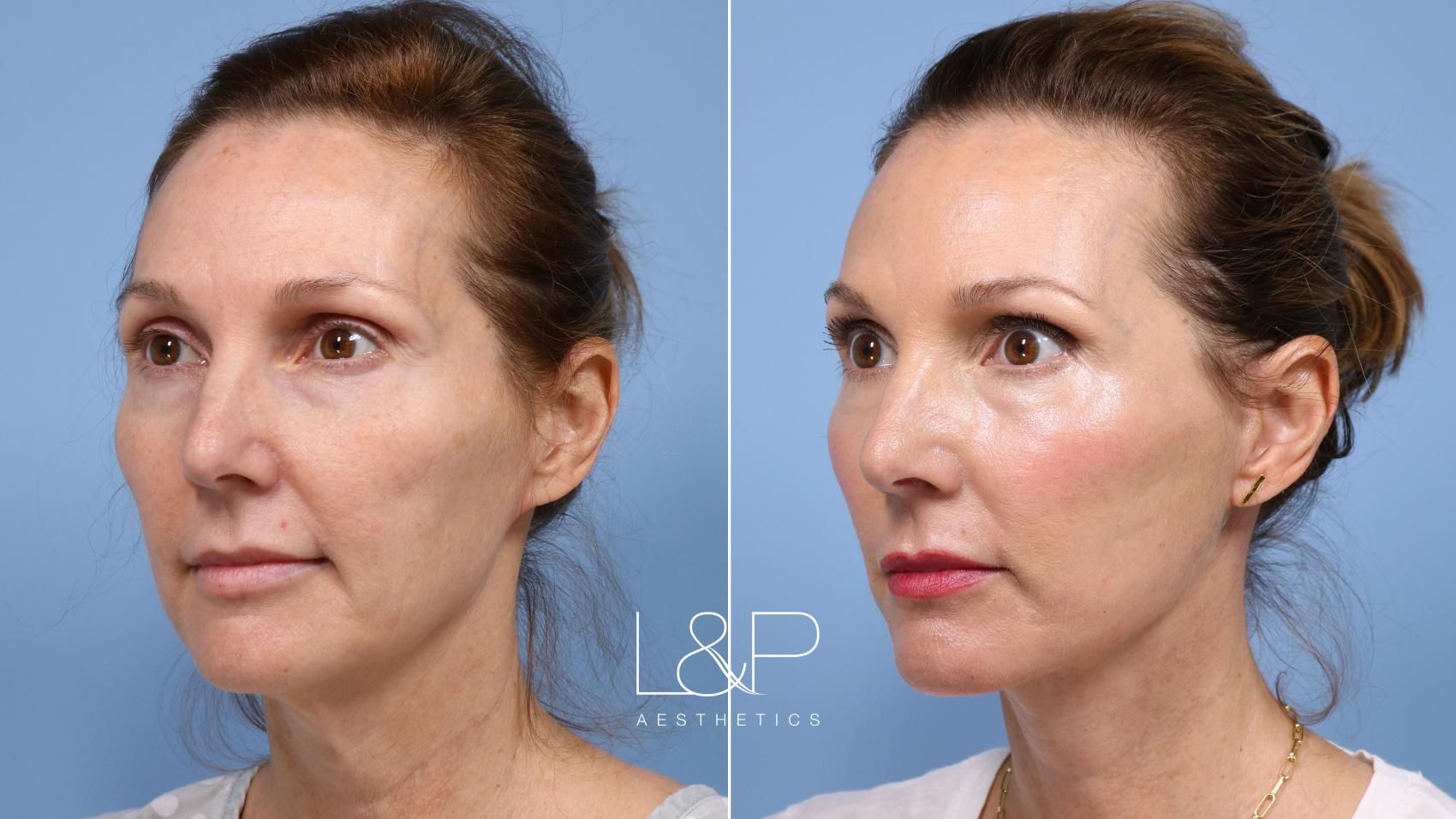 Facelift Neck Lift before and after treatment in Los Gatos, CA