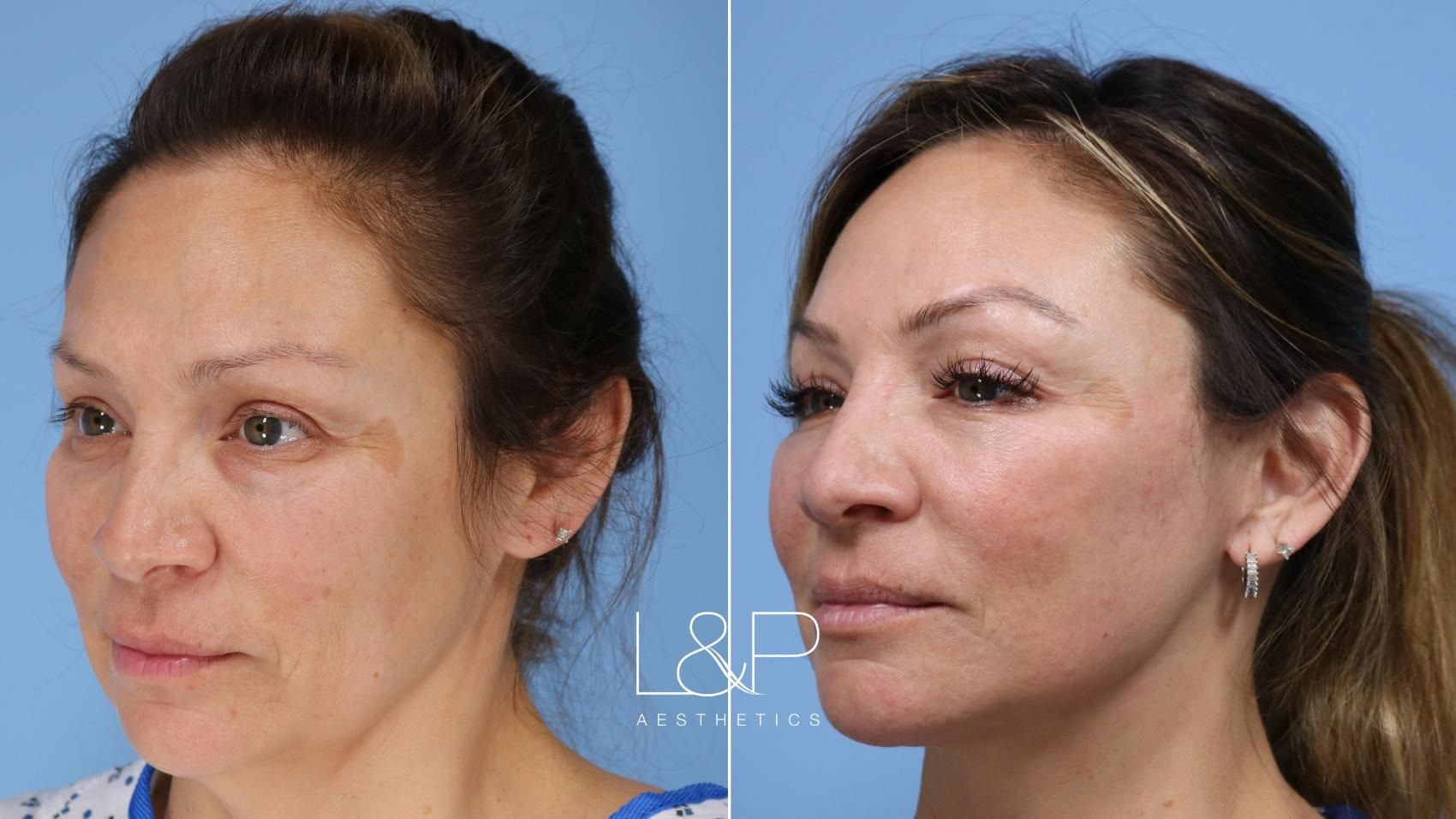 Facelift Neck Lift before and after treatment in California