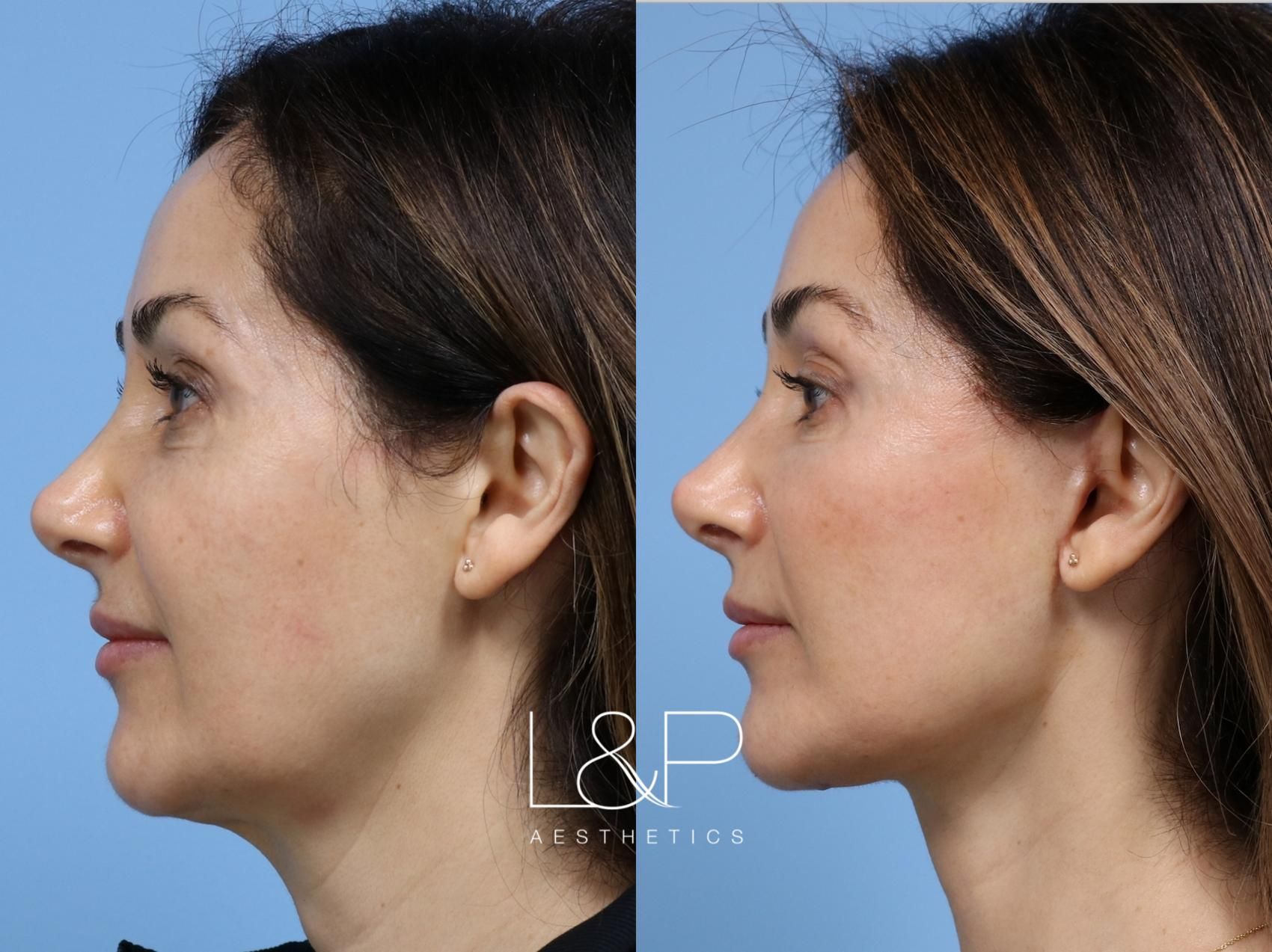 Facelift Neck Lift before and after treatment in California
