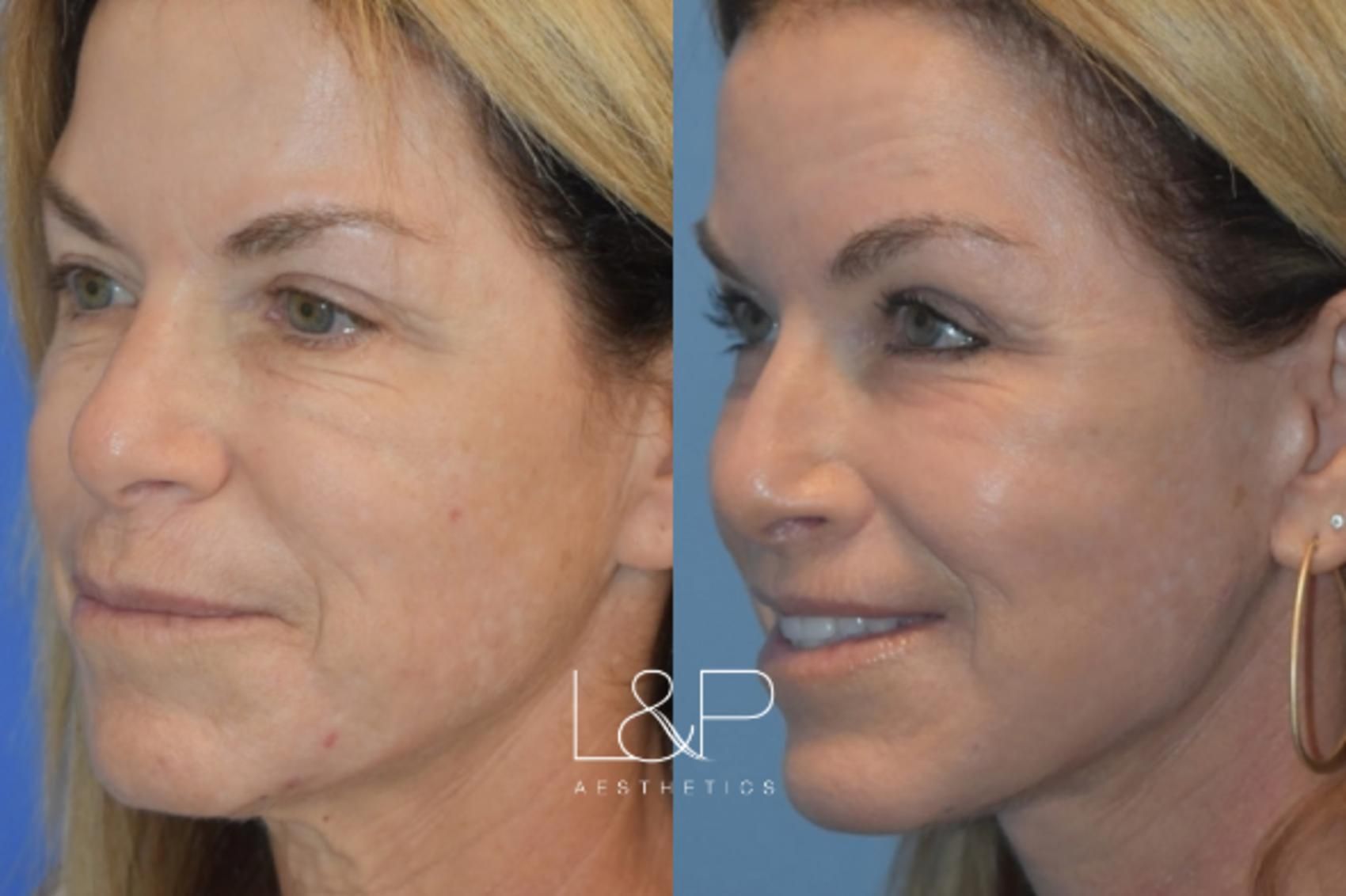 Facelift Neck Lift before and after treatment in Palo Alto, CA
